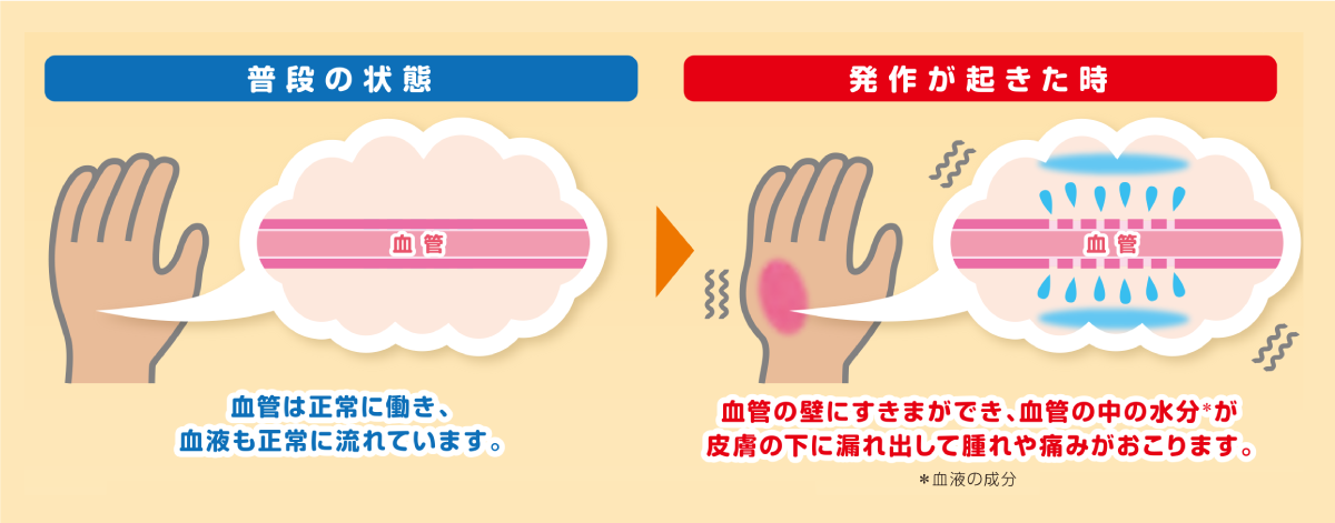 HAE（遺伝性血管性浮腫）の発作の原因は、“血管からの水漏れ”です